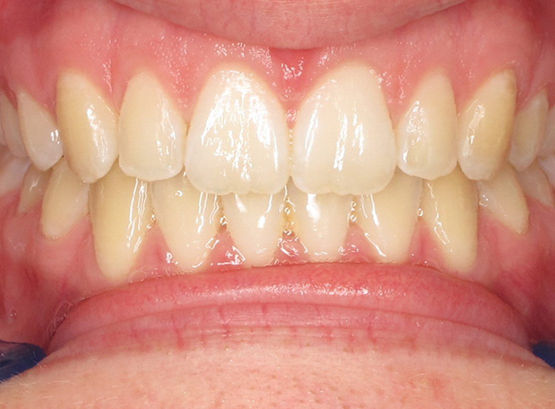 After Invisalign (gap teeth)